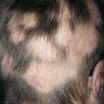 Haarausfall Alopezie Behandlung Hautarzt Frankfurt