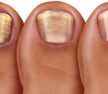 Nagelpilz Hautarzt
