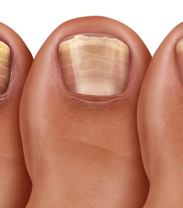 Nagelpilz Hautarzt