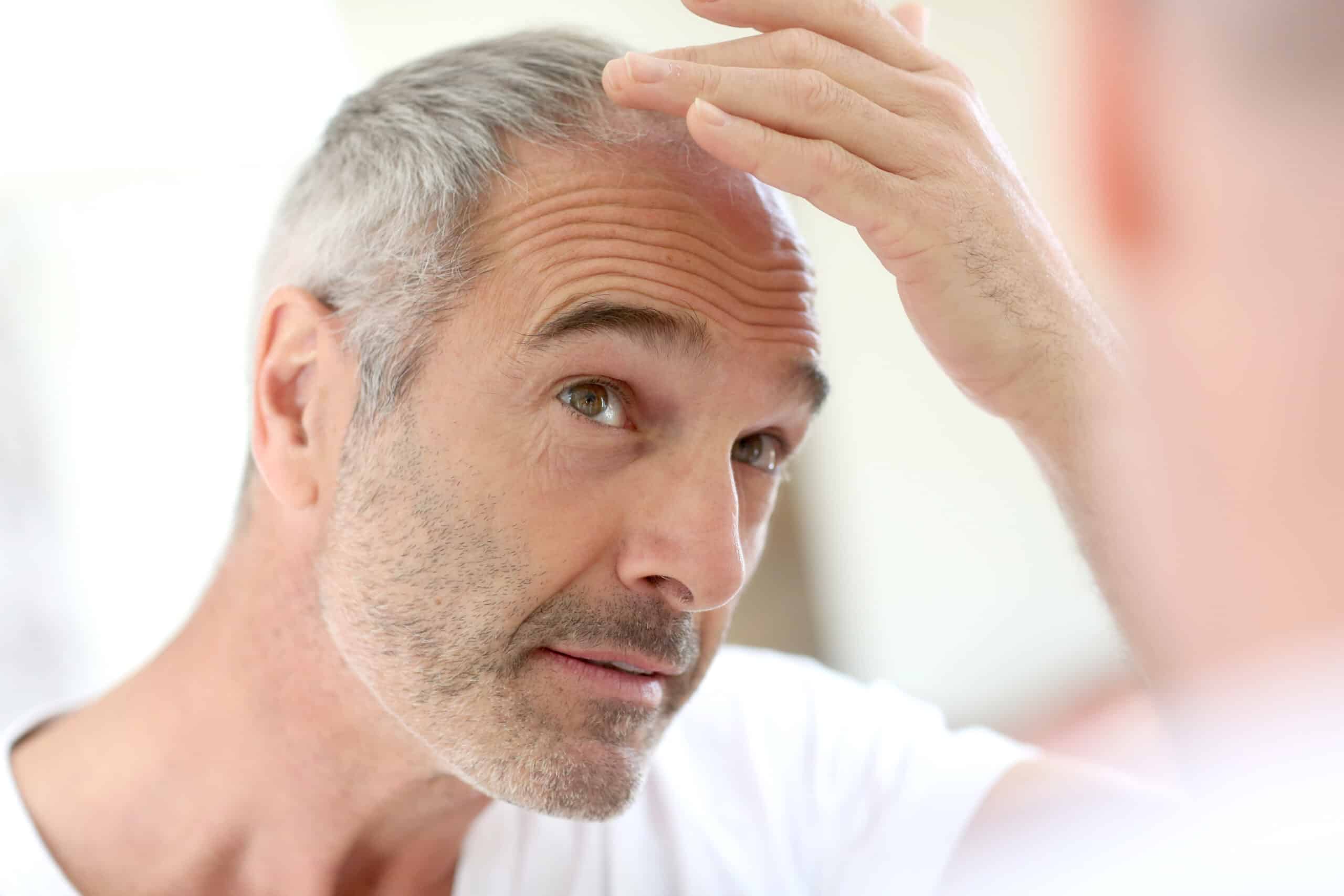 Haarausfall Arzt Frankfurt Alopezie
