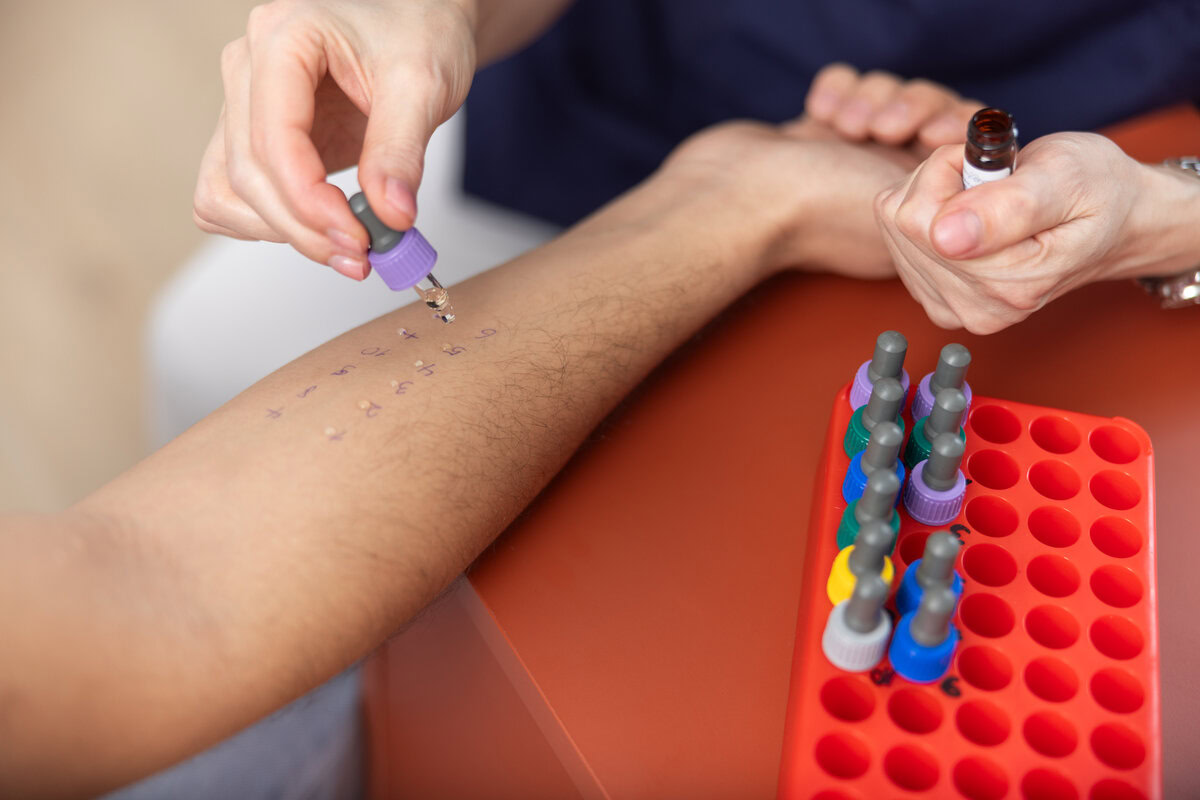 Prick test Frankfurt allergy test